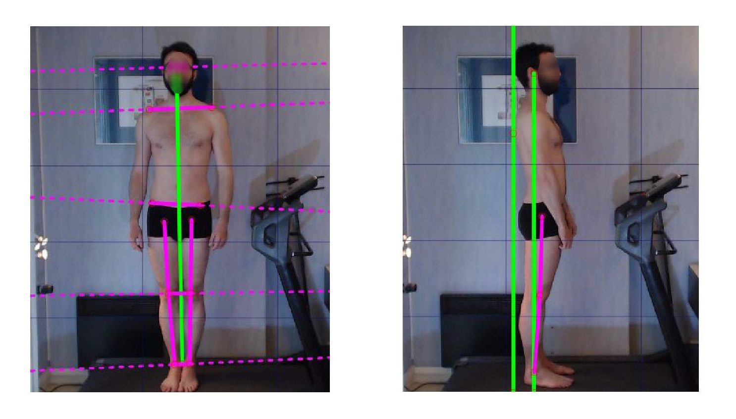 Podologue, podologie, posture, posturologie, sport, podologue du sport, équilibre, biomécanique, bilan postural, bilan podologique, semelles orthopédiques, semelles posturales, orthèses plantaires, mal de dos, lombalgie, cervicalgie, maux de tête, arthrose, arthrite, tendinite, TFL, patte d’oie, épine calcanéenne, myo-aponévrosite, hallux valgus, hallux rigidus, griffes d’orteil, Morton, cors, durillons, scoliose, fibromyalgie, instabilité, vertiges, ostéopathie, Essonne, Vigneux, Paris.